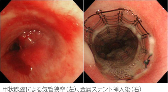 甲状腺癌による気管狭窄（左）、金属ステント挿入後（右）