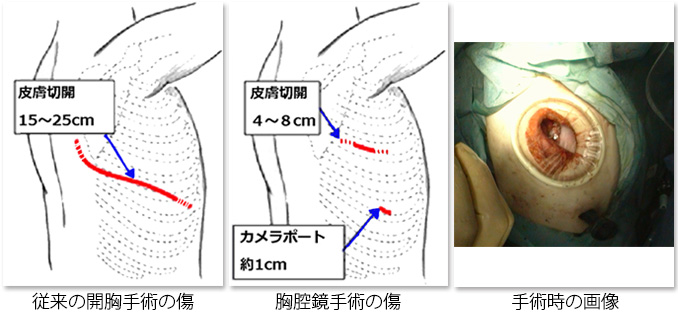 従来の開胸手術の傷　胸腔鏡手術の傷　手術時の画像